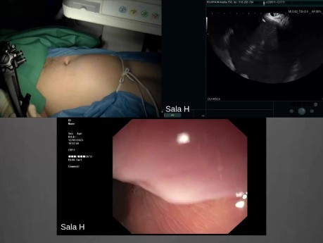 Endoskopowa cystogastrostomia martwicy ograniczonej trzustki