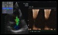 Arytmogenna kardiomiopatia/dysplazja PK - przypadek kliniczny, EKG, ECHO