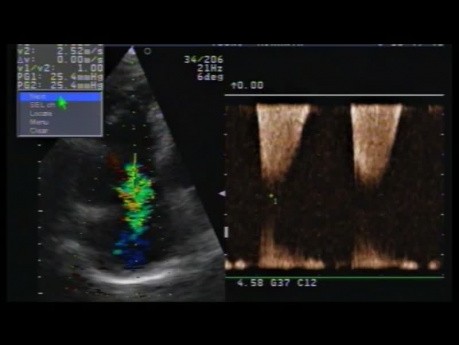 Arytmogenna kardiomiopatia/dysplazja PK - przypadek kliniczny, EKG, ECHO