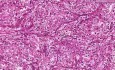 Rak nerkowokomórkowy - histopatologia - nerka