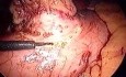 Nowotwór podścieliska przewodu pokarmowego - laparoskopia