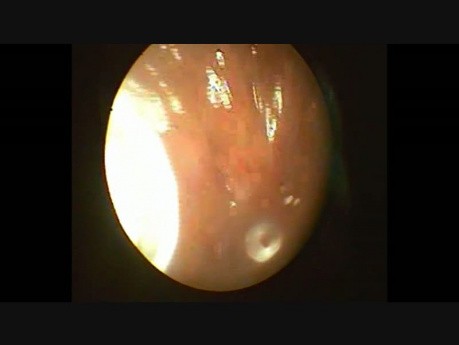 Dysfunkcja trąbek słuchowych wtórna do przewlekłego zapalenia zatok przynosowych z polipami