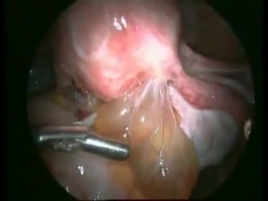 Laparoskopowe wycięcie odbytniczo-pochwowych guzków z ogniskami endometriozy