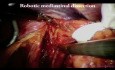 Ezofagektomia przy użyciu robota