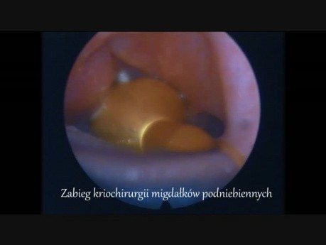 Kriochirurgia przerostu migdałków podniebiennych