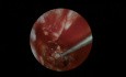 Tympanoplastyka przewlekłego ropnego zapalenia ucha środkowego 