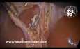 Ostre zapalenie pęcherzyka żółciowego ułatwia cholecystektomię laparoskopową