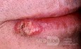 Plattenepithelkarzinom der Lippe