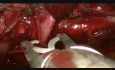 Wideotorakoskopowa technika hemostazy dużego guza w celu uniknięcia pulmonektomii
