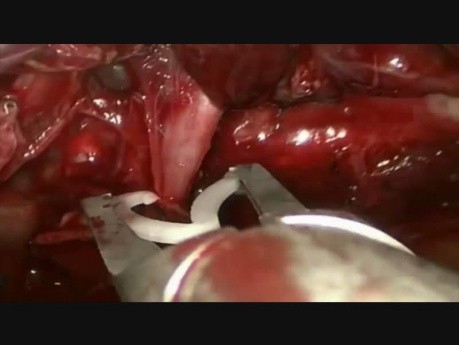 Wideotorakoskopowa technika hemostazy dużego guza w celu uniknięcia pulmonektomii