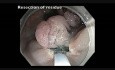 Kolonoskopia: endoskopowa resekcja śluzówkowa olbrzymiego polipa odbytnicy