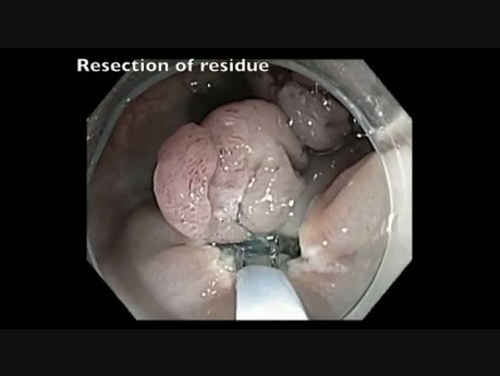 Kolonoskopia: endoskopowa resekcja śluzówkowa olbrzymiego polipa odbytnicy