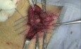 Ogromna przepuklina pachwinowa - operacja z użyciem siatki i kleju tkankowego