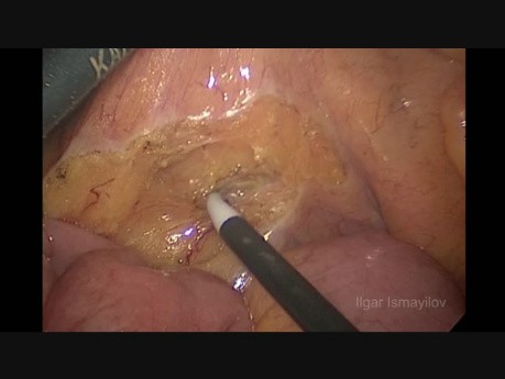 Laparoskopowa lewostronna hemikolektomia z usunięciem krezki z powodu raka esicy