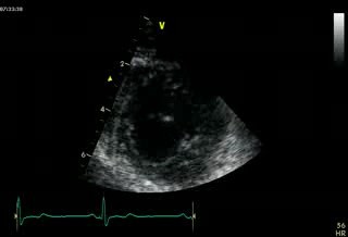 Prawidłowa echokardiografia, obraz w osi mostkowej na poziomie koniuszka