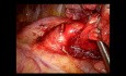 Wideotorakoskopowa lobektomia lewa górna w technice fissure-less (film niezedytowany)