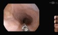 Gastropatia nadżerkowa, przypadek kliniczny
