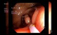 EMR of Periappendiceal Lesion after Partial Circumferential Mucosal Incision