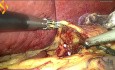 Laparoskopowa gastrektomia z powodu nowotworu podścieliskowego (GIST) krzywizny mniejszej żołądka 