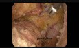Laparoskopowa przednia niska resekcja odbytnicy z powodu raka