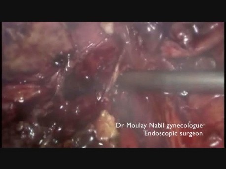 Ureteroliza z powodu głęboko naciekającej endometriozy, metoda "shaving"