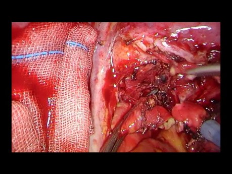Podwójna lobektomia rękawowa metodą Uniportal VATS z dojścia przez worek osierdziowy (Intrapericardial) z użyciem kleszczy naczyniowych