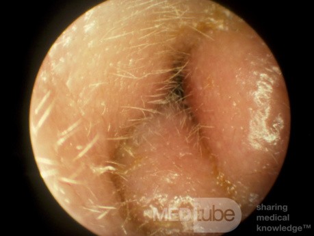 Ciężkie ostre zapalenie ucha zewnętrznego z niedrożnością przewodu