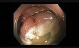 Kolonoskopia - mukozektomia endoskopowa (EMR) poprzecznicy - zmiana ustawienia pętli chirurgicznej