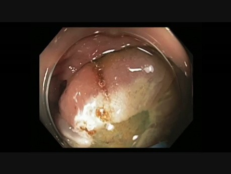 Kolonoskopia - mukozektomia endoskopowa (EMR) poprzecznicy - zmiana ustawienia pętli chirurgicznej