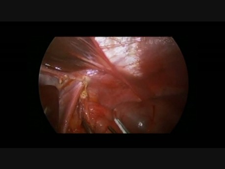Jednoczasowa laparoskopowa operacja Ladda, appendektomia i fundoplikacja Nissena