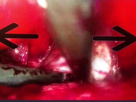 Procedura vNOTES przedniej otrzewnej pęcherzowo-macicznej