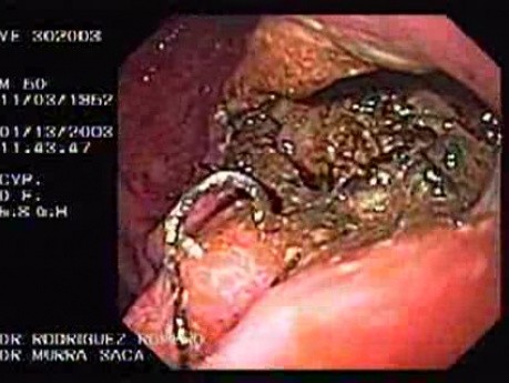 Cystogastrostomia (2 z 5)