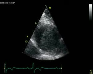 Koniuszkowa kardiomiopatia przerostowa