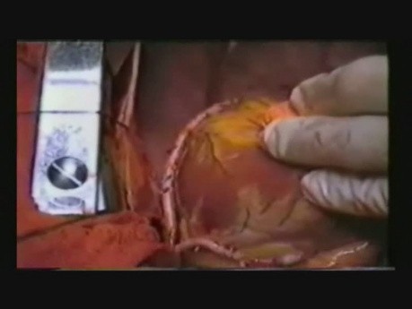 Pomostowanie aortalno wieńcowe obiema tętnicami piersiowymi wewnętrznymi techniką zespoleń pomostów typu Y-graft