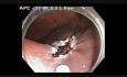 Kątnica - płaska zmiana - endoskopowa mukozektomia
