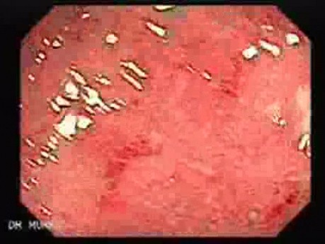Wrzodziejące zapalenie jelita grubego - pseudopolipy (2 z 22)