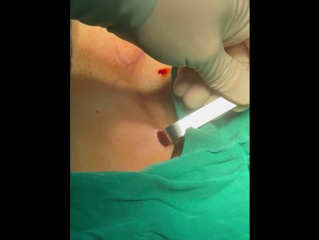 Dwuportowa przezpodobojczykowa endoskopowa operacja tarczycy (część 0)