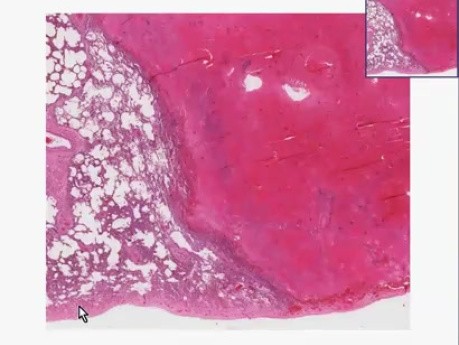 Świeży zawał - histopatologia płuca