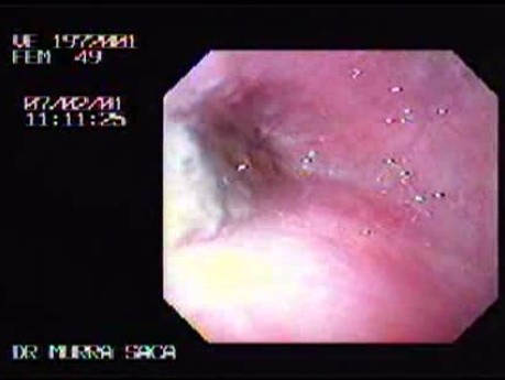 Gruczolak cewkowo - kosmkowy - endoskopia (1 z 28)