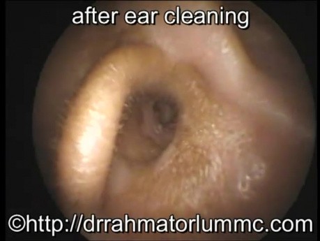 Samorozprężalny drenik tympanostomijny u pacjenta z przetrwałym wysiękowym zapaleniem ucha środkowego