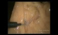 Laparoskopowa przednia niska resekcja odbytnicy (LAR) z powodu raka odbytnicy