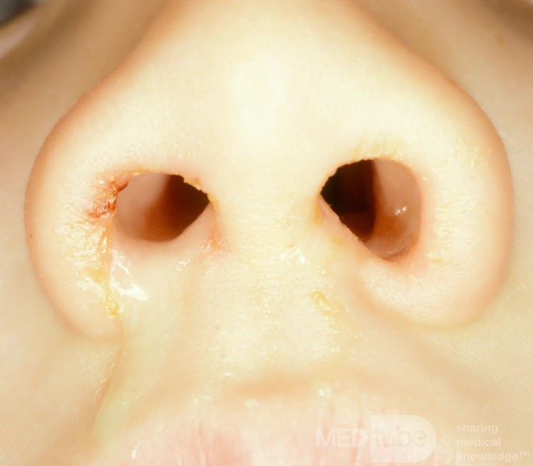 Jednostronna wydzielina z jamy nosowej z ciałem obcym