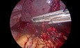 Laparoscopic Splenectomy Following Spontaneous Splenic Rupture