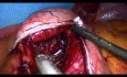 Operacja żołądka metodą Gastric bypass - część 4