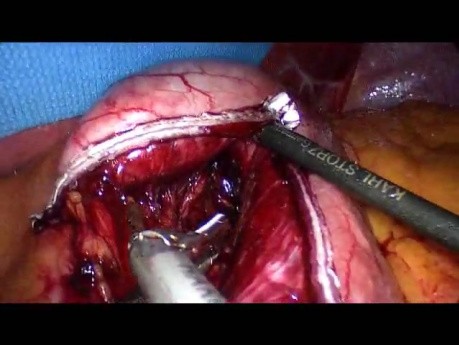 Operacja żołądka metodą Gastric bypass - część 4