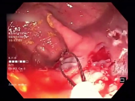 Resekcja endoskopowa zmiany o typie LST-G wstępnicy techniką mukozektomii