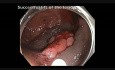 Kątnica - polip dywanowy - endoskopowa mukozektomia: ostrzyknięcie, resekcja i koagulacja