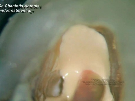 Obturacja kanału trzonowca szczęki pod powiększeniem