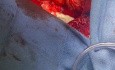 Pacjent bez płuc na żylno-tętniczym pozaustrojowym natlenianiu membranowym (VA-ECMO) oczekujący na przeszczep
