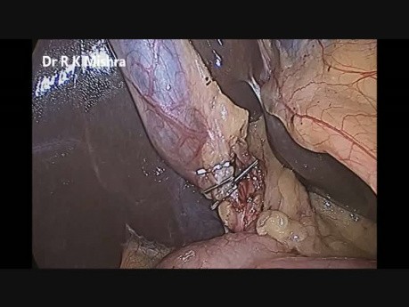 Dwa porty do cholecystektomii laparoskopowej 